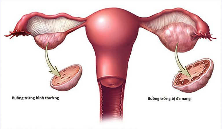 Mách bạn cách chữa buồng trứng đa nang bằng tây y