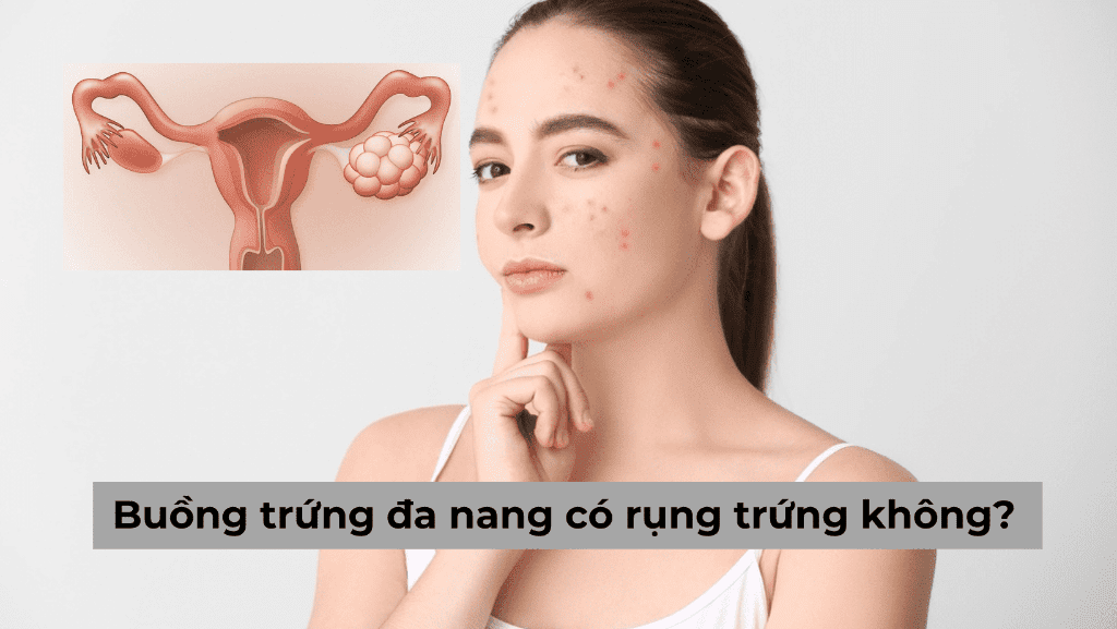 Mách bạn cách chữa buồng trứng đa nang bằng tây y