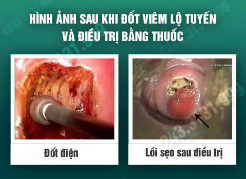 Chuyên đề điều trị viêm lộ tuyến