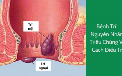 [Lời khuyên] – Bệnh Trĩ : Nguyên Nhân, Triệu Chứng Và Cách Điều Trị