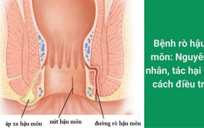 Bệnh rò hậu môn: Nguyên nhân, tác hại và cách điều trị