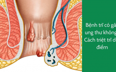 Bệnh trĩ có gây ung thư không? Cách triệt trĩ dứt điểm
