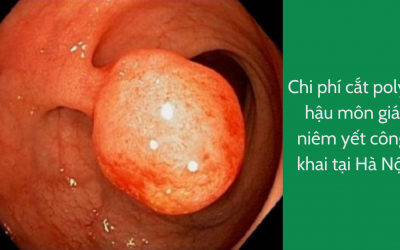Chi phí cắt polyp hậu môn giá niêm yết công khai tại Hà Nội