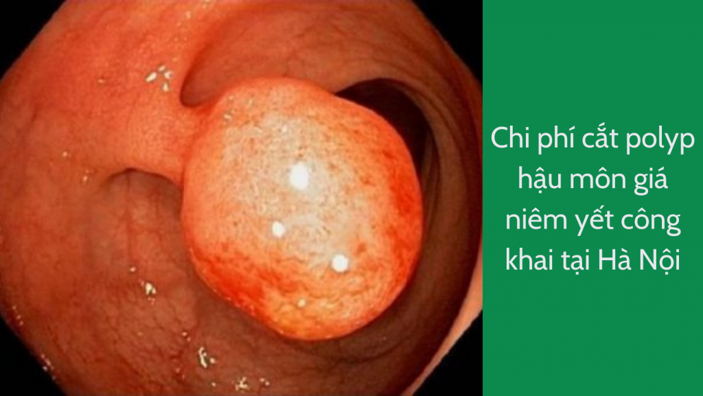 Chi phí cắt polyp hậu môn giá niêm yết công khai tại Hà Nội