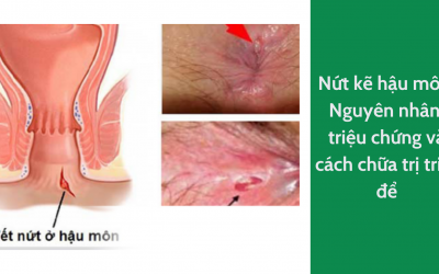 Nứt kẽ hậu môn: Nguyên nhân, triệu chứng và cách chữa trị triệt để