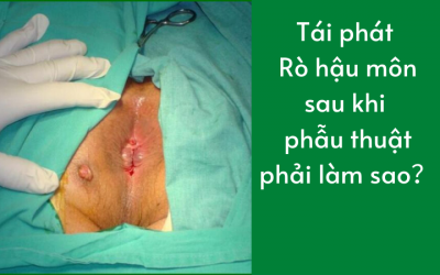 Tái phát rò hậu môn sau khi phẫu thuật phải làm sao?