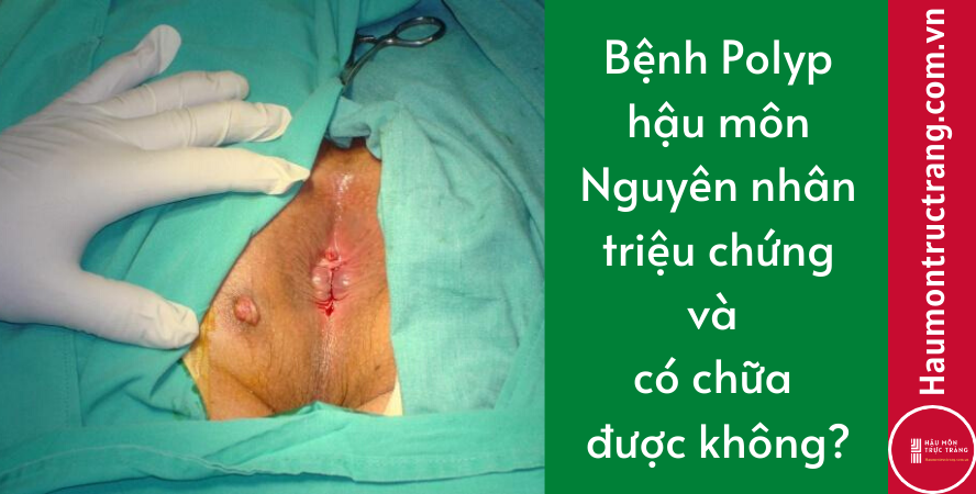 Bệnh Polyp hậu môn: Nguyên nhân, triệu chứng và có chữa được không?