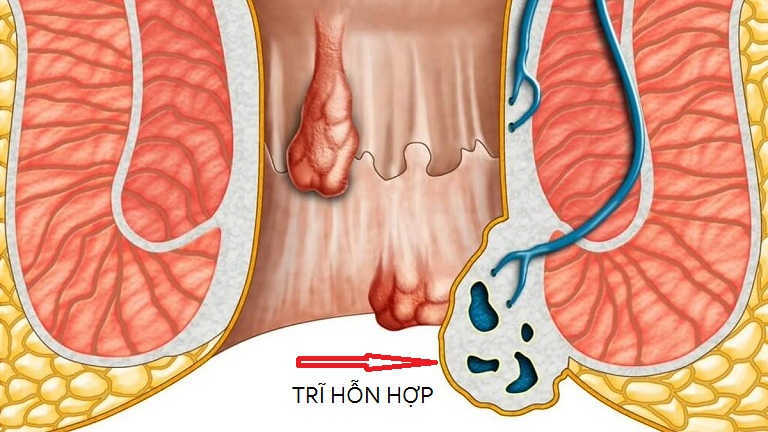 Địa chỉ chữa bệnh trĩ ở hải phòng