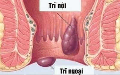 Chữa bệnh trĩ bằng thực dưỡng có hiệu quả và triệt để?