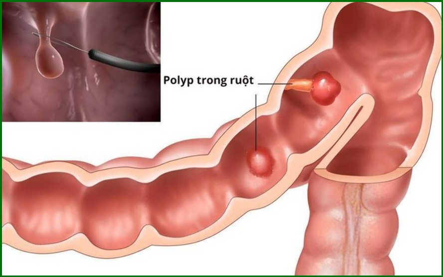 Phương pháp điều trị polyp hậu môn bằng can thiệp ngoại khoa