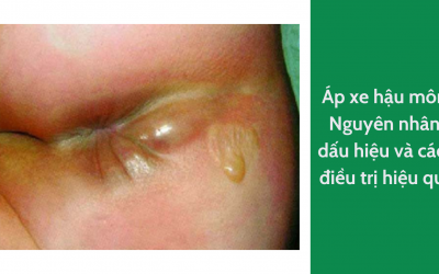 Áp xe hậu môn: Nguyên nhân, dấu hiệu và cách điều trị hiệu quả