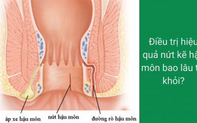 [Giải đáp] Điều trị hiệu quả nứt kẽ hậu môn bao lâu thì khỏi?