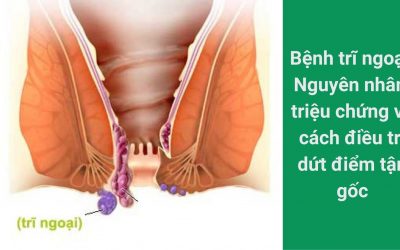 Bệnh trĩ ngoại: Nguyên nhân, triệu chứng và cách điều trị dứt điểm tận gốc