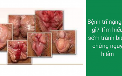 Bệnh trĩ nặng là gì? Tìm hiểu sớm tránh biến chứng nguy hiểm