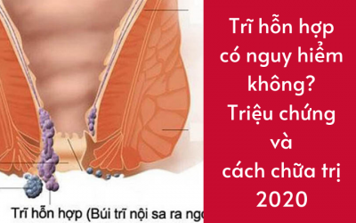 Bệnh trĩ hỗn hợp có nguy hiểm không? Triệu chứng và cách chữa trị