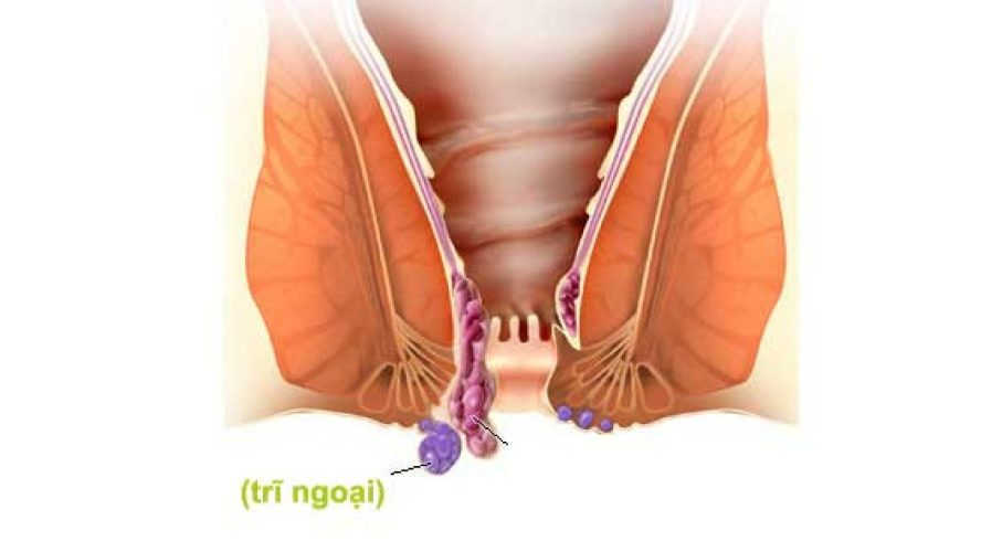 Phân biệt bệnh trĩ nội và trĩ ngoại