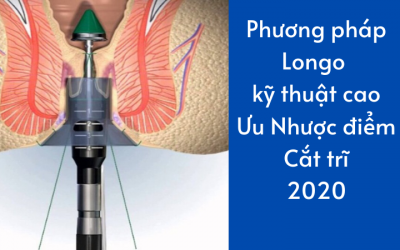 Phương pháp Longo kỹ thuật cao: Ưu và Nhược điểm khi cắt trĩ