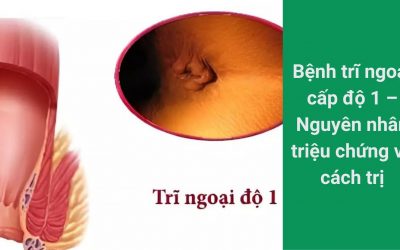 Bệnh trĩ ngoại cấp độ 1 – Nguyên nhân triệu chứng và cách trị