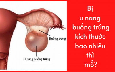 Bị u nang buồng trứng kích thước bao nhiêu thì mổ?