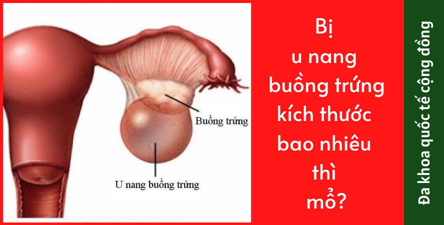 Bị u nang buồng trứng kích thước bao nhiêu thì mổ?
