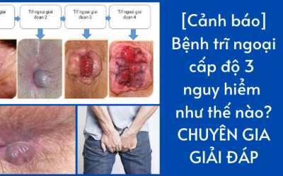 [Cảnh báo] Bệnh trĩ ngoại cấp độ 3 nguy hiểm như thế nào?