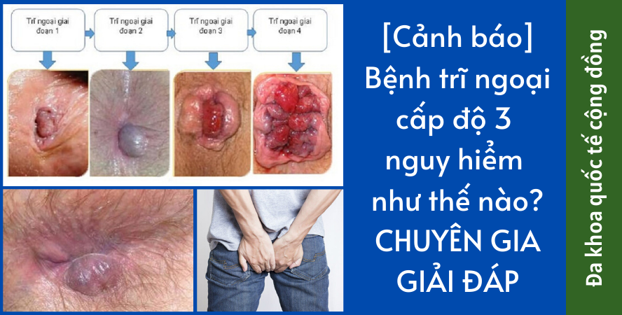 [Cảnh báo] Bệnh trĩ ngoại cấp độ 3 nguy hiểm như thế nào?