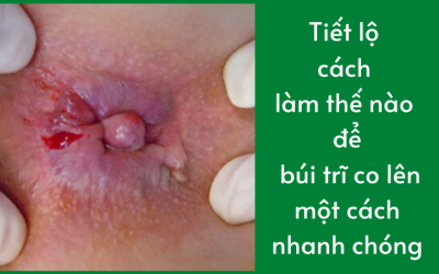 Tiết lộ cách làm thế nào để búi trĩ co lên một cách nhanh chóng