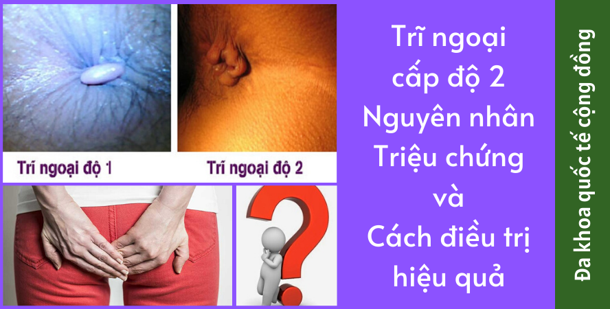 Trĩ Ngoại Cấp Độ 2 } – Nguyên Nhân, Dấu Hiệu Và Điều Trị Tại Nhà