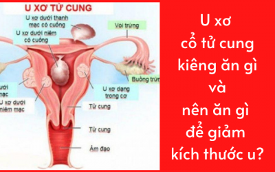 U xơ cổ tử cung kiêng ăn gì và nên ăn gì để giảm kích thước u?