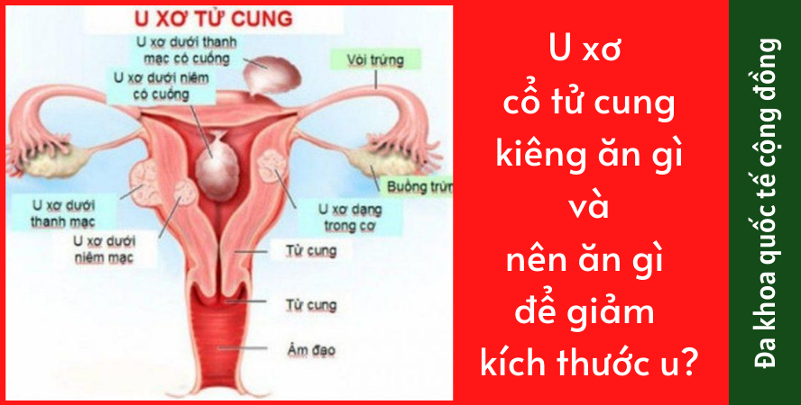 Mức độ ăn hải sản nào là phù hợp cho người mắc u xơ tử cung? 
