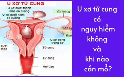 U xơ tử cung có nguy hiểm không và khi nào cần mổ?