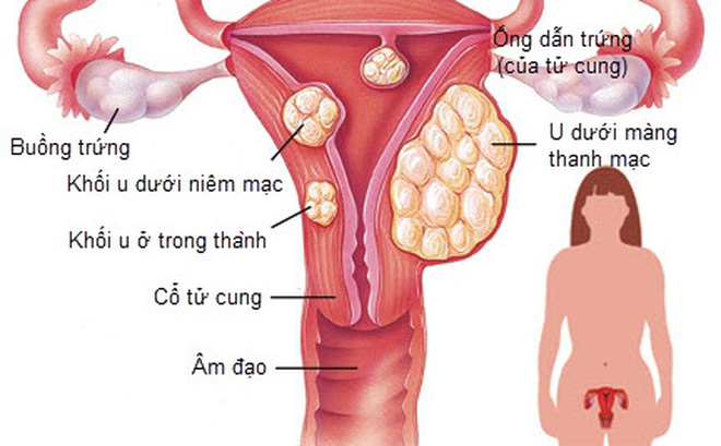 U xơ tử cung phát triển thành ung thư