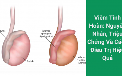 Viêm Tinh Hoàn: Nguyên Nhân, Triệu Chứng Và Cách Điều Trị Hiệu Quả