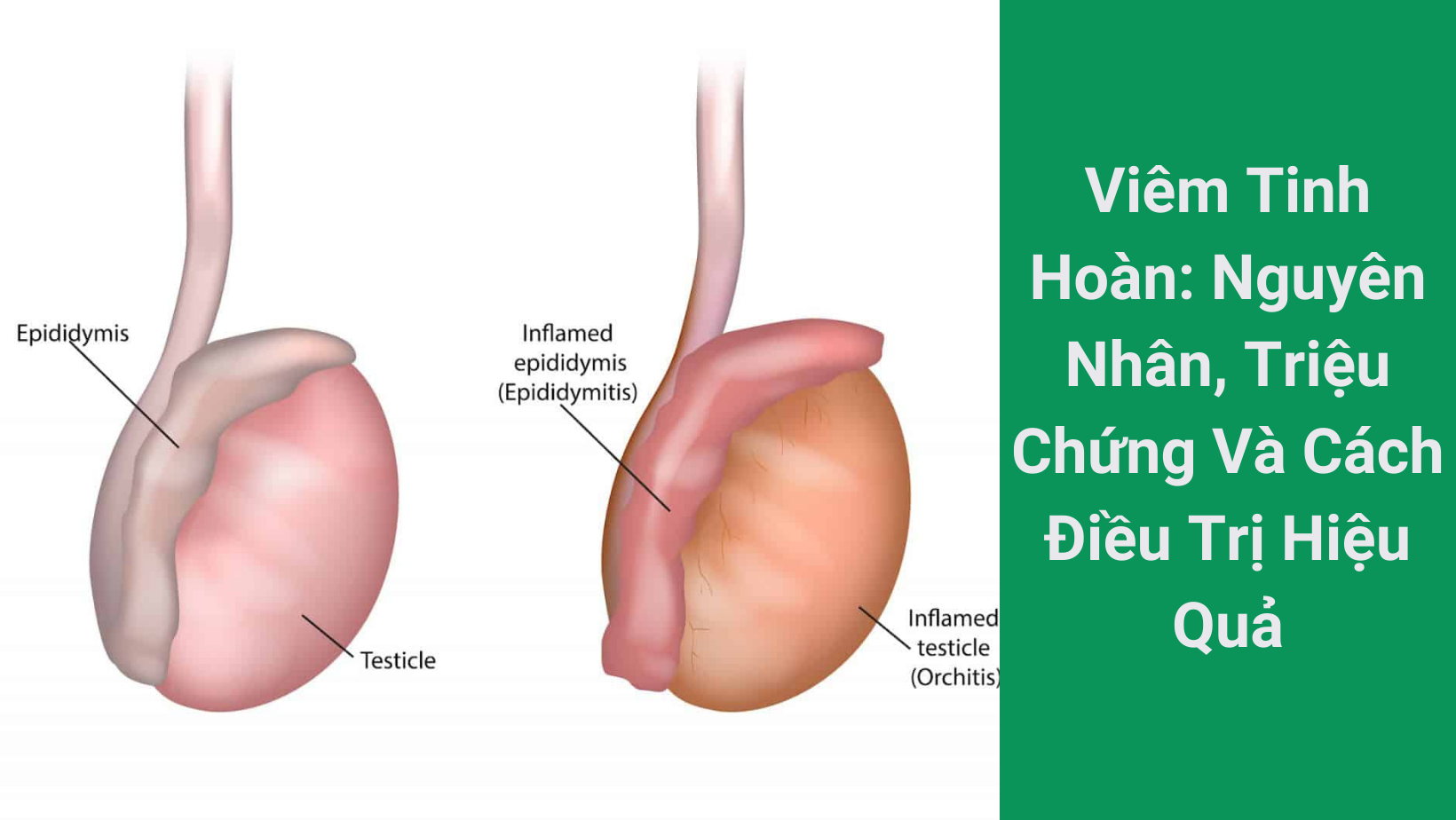 Viêm Tinh Hoàn: Nguyên Nhân, Triệu Chứng Và Cách Điều Trị Hiệu Quả