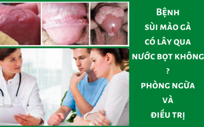 Bệnh sùi mào gà có lây qua nước bọt không? Cách phòng ngừa và điều trị