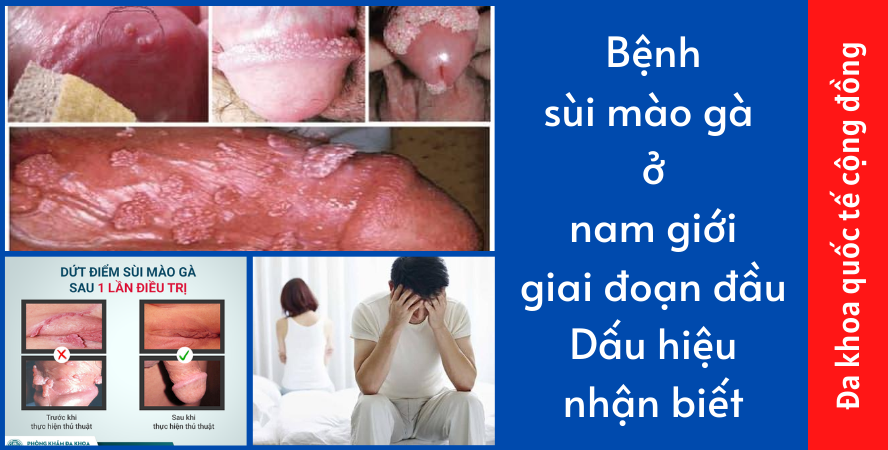 Bệnh Sùi Mào Gà ở Nam Giới Giai đoạn đầu Dấu Hiệu Nhận Biết 