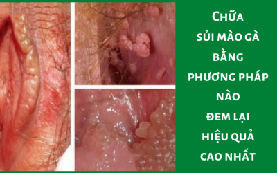 Chữa sủi mào gà bằng phương pháp nào đem lại hiệu quả cao nhất