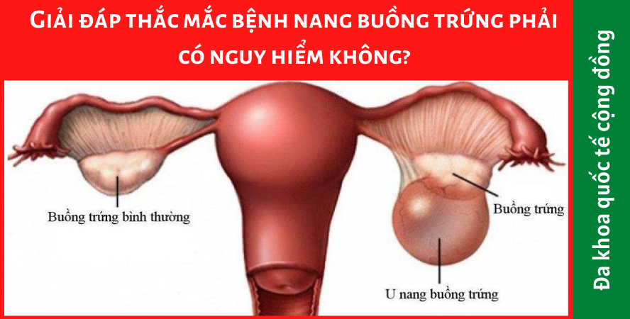 Giải đáp thắc mắc bệnh nang buồng trứng phải có nguy hiểm không