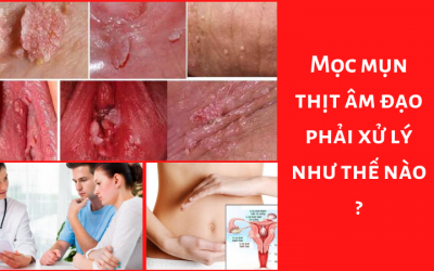 Mọc Mụn Thịt Âm Đạo Phải Xử Lý Như Thế Nào?