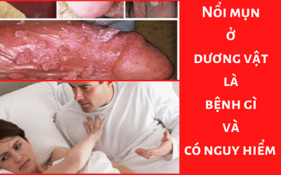 Nổi mụn ở dương vật là bệnh gì và có nguy hiểm không?