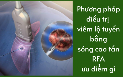 Phương pháp điều trị viêm lộ tuyến bằng sóng cao tần RFA