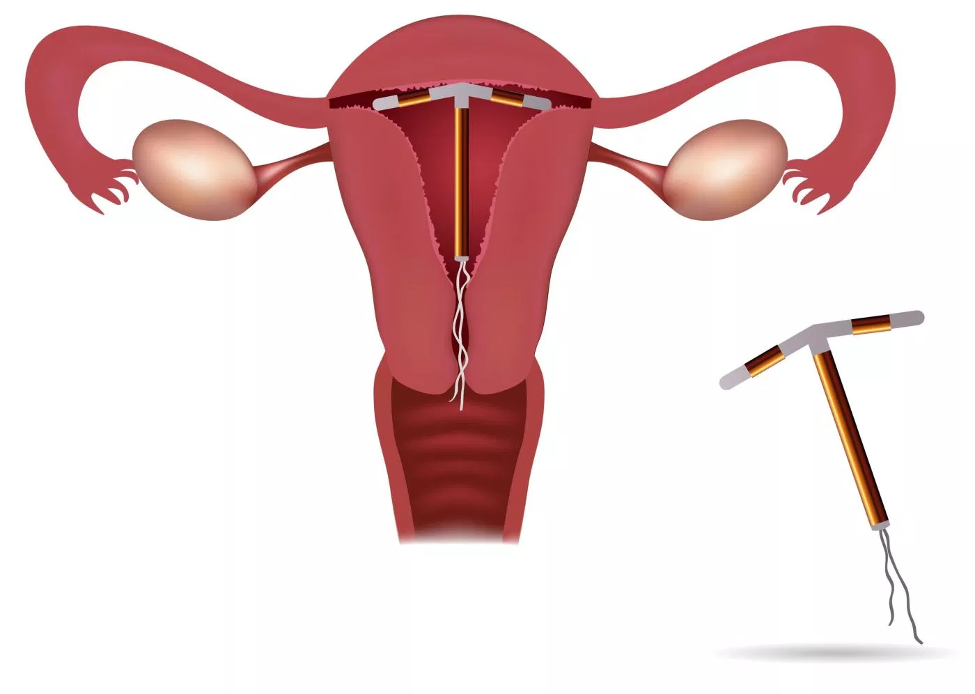 Tư vấn Vòng tránh thai nội tiết
