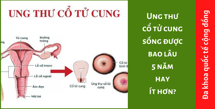 Ung thư cổ tử cung sống được bao lâu, 5 năm hay ít hơn?