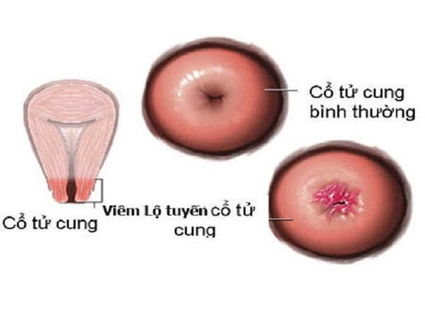 Dấu hiệu của viêm lộ tuyến cổ tử cung hoặc viêm cổ tử cung và tử cung