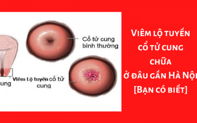 Viêm lộ tuyến cổ tử cung chữa ở đâu gần Hà Nội [Bạn có biết]