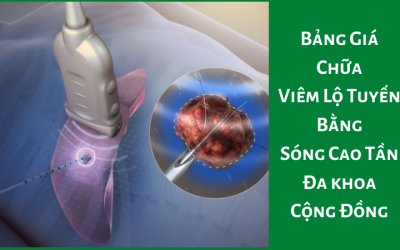 Bảng giá chữa viêm lộ tuyến bằng sóng cao tần