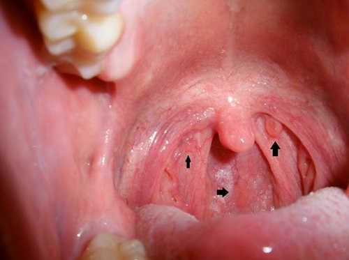 Bệnh sùi mào gà ở miệng giai đoạn đầu triệu chứng, cách chữa trị