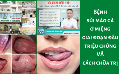 Bệnh sùi mào gà ở miệng giai đoạn đầu triệu chứng, cách chữa trị