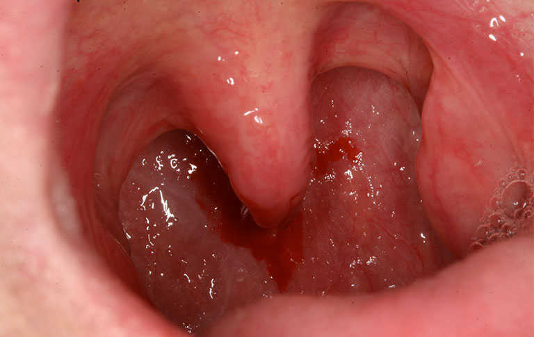 Bệnh sùi mào gà ở miệng giai đoạn đầu triệu chứng, cách chữa trị