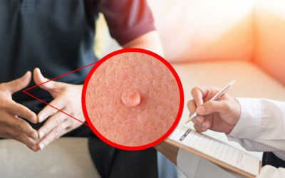 Danh sách 8 cách chữa sùi mào gà bằng dân gian phổ biến hiện nay